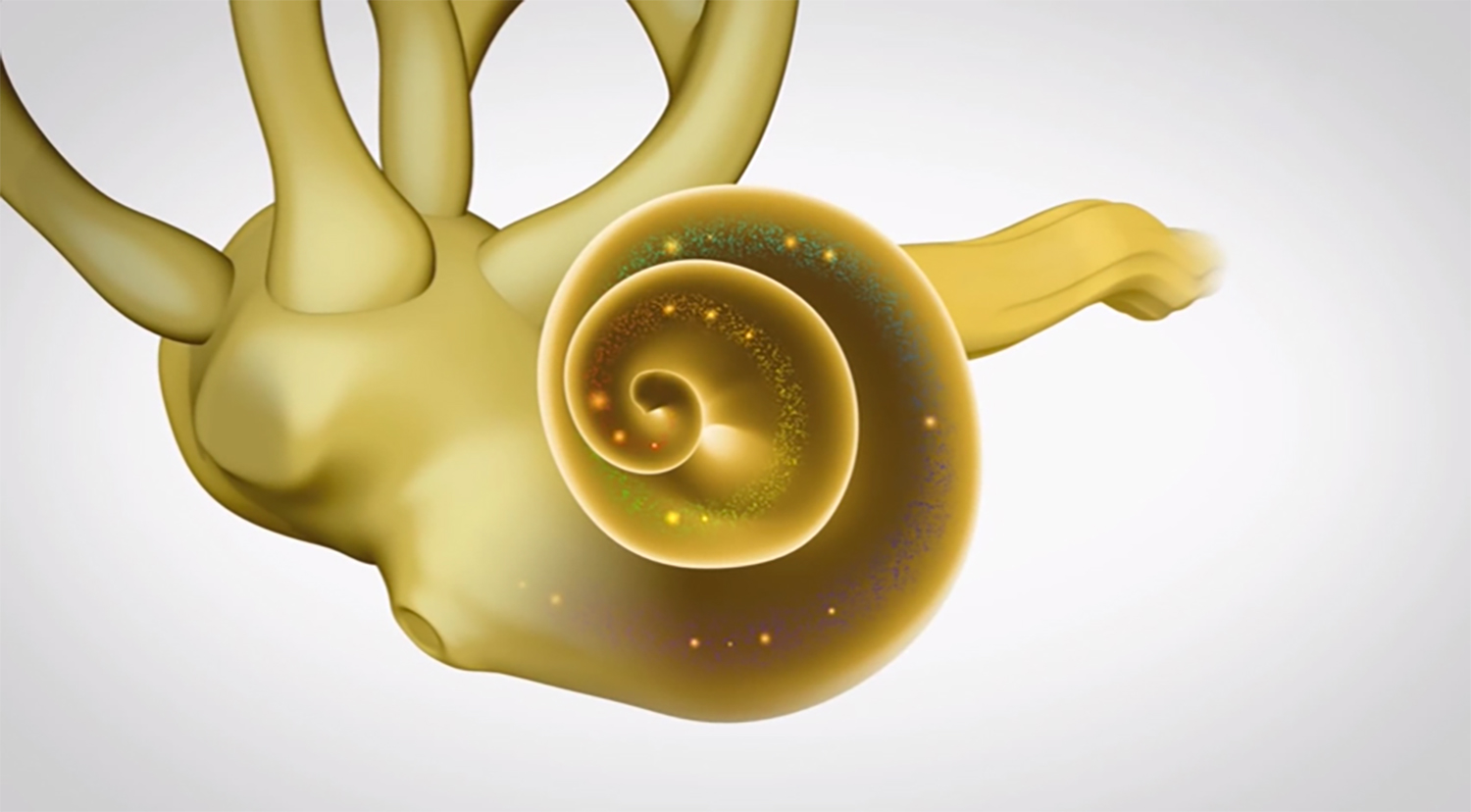 hearing_loss_sensorineural-1